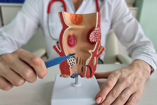 Effective Hemorrhoid Treatment Options For Lasting Relief