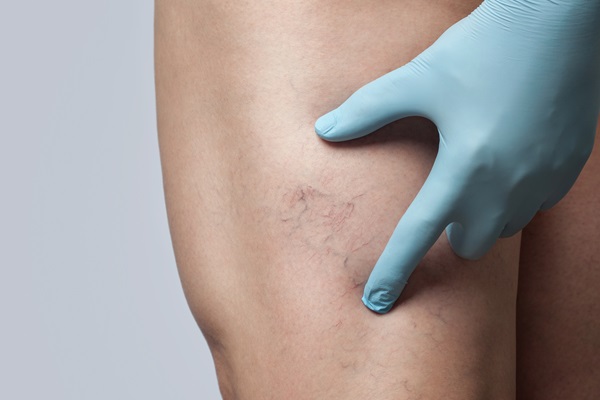 What Are The Different Varicose Vein Treatments?